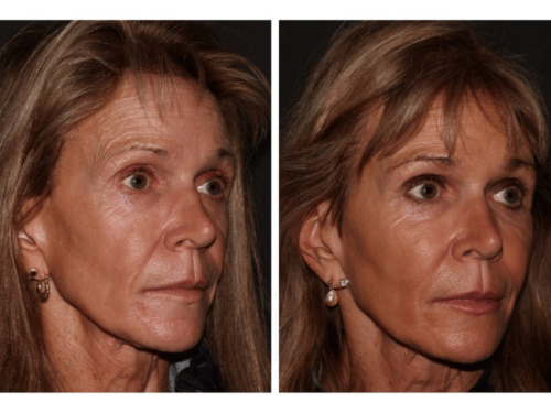 Why we love “fat transfer”