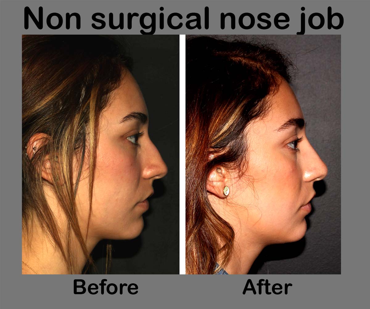 What Is the Best Age for Getting Rhinoplasty? Boulder CO - Boulder Plastic  Surgery