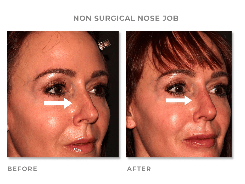 Non Surgical Nose Job Before & After Pictures