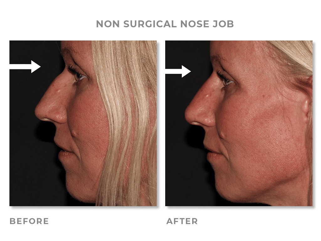 Katie nose final