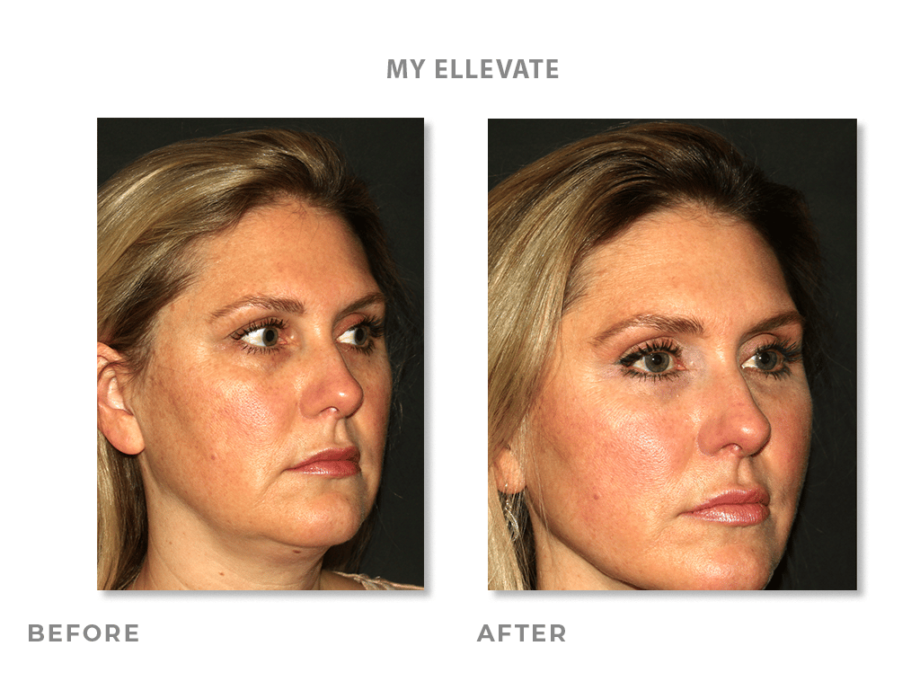 Ally Ellevate before and after photos