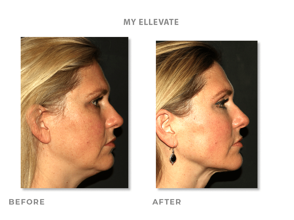 Ally Profile Ellevate Before & After