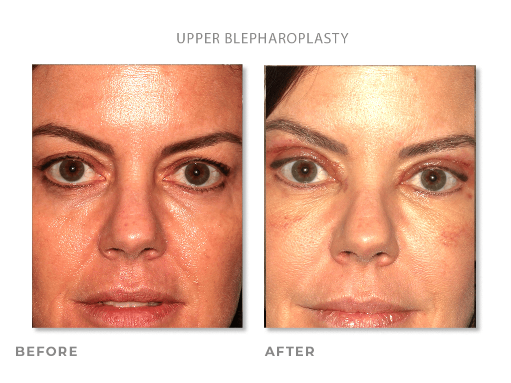 Upper Blepharoplasty before and after photo of woman with clearer skin