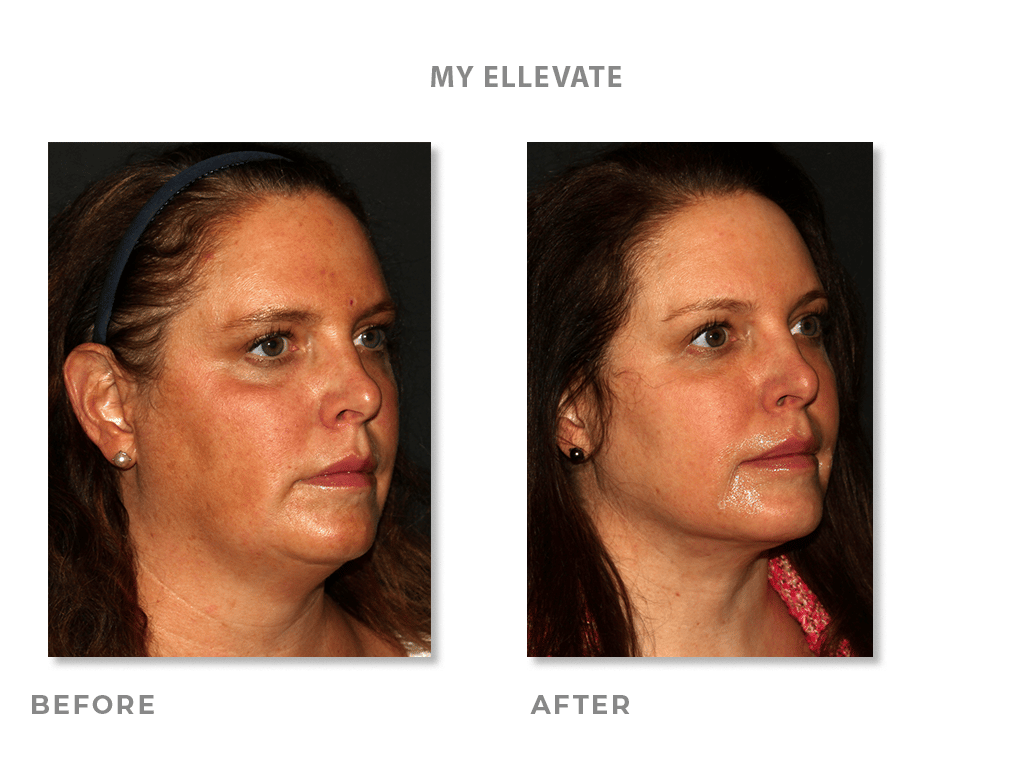 Ellevate Before & After Pictures