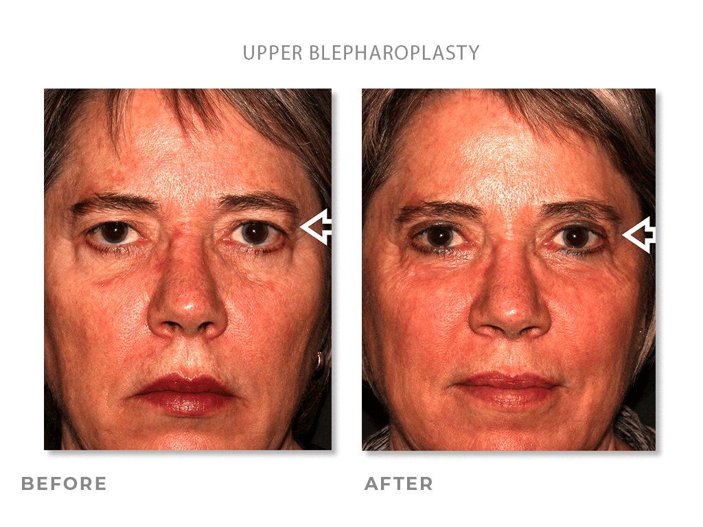 Upper Blepharoplasty before and after photos