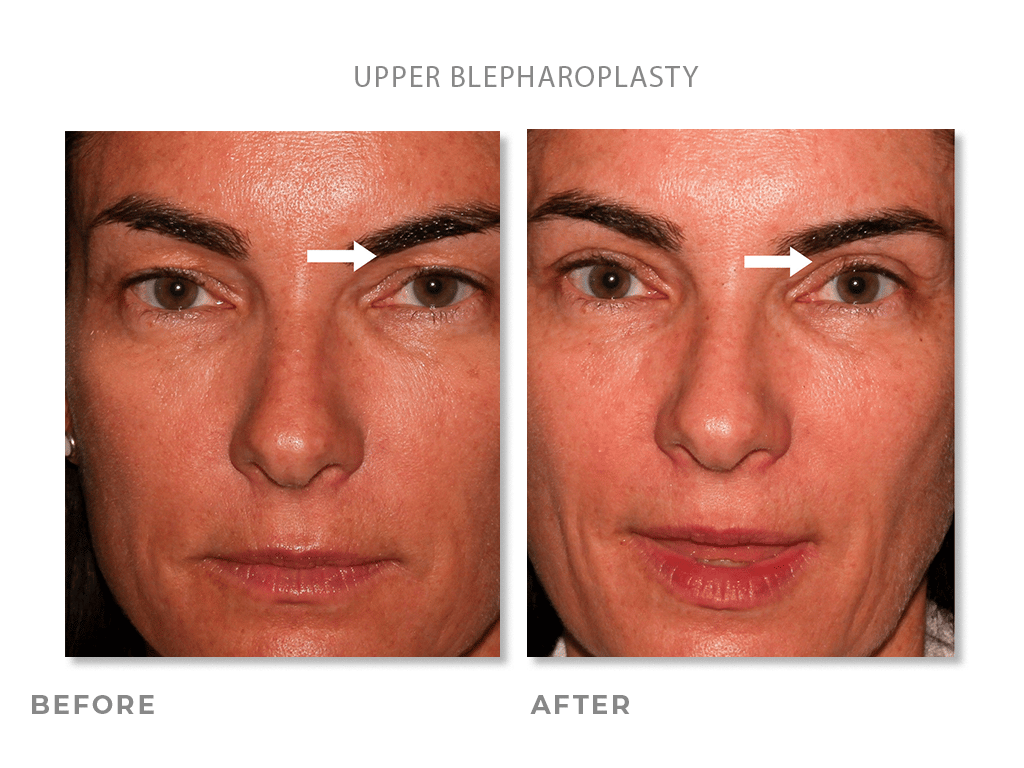 Upper Blepharoplasty before and after photos