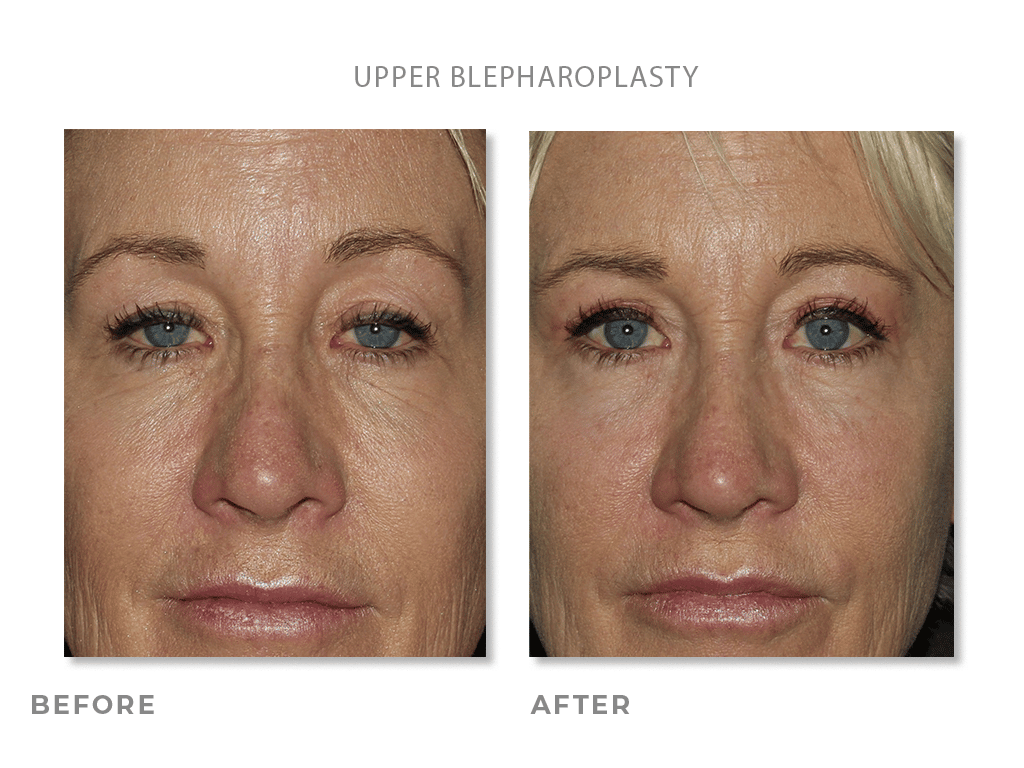 Upper Blepharoplasty before and after photos