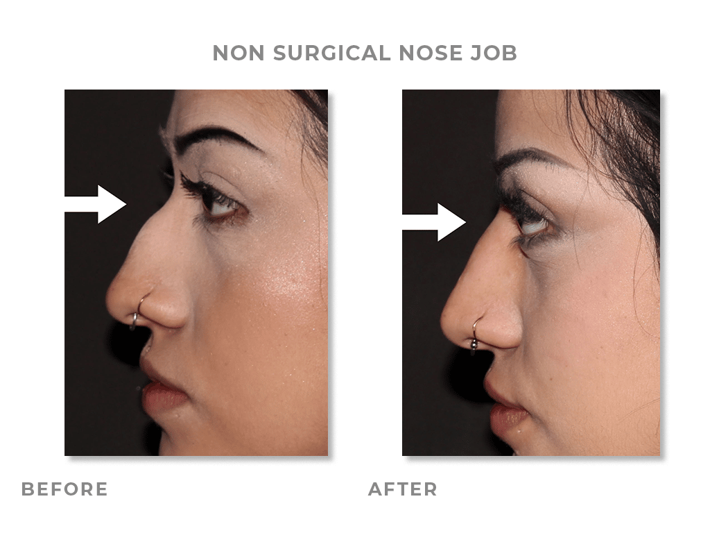 Non Surgical Nose Job Before & After Pictures