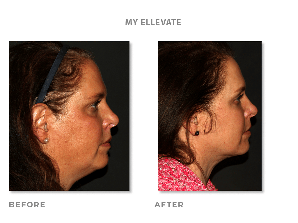 Profile of Ellevate Before & After Pictures