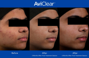 Aviclear before and after photos