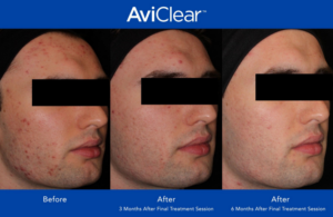 Aviclear before and after photos 2 clear skin