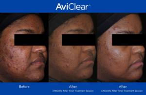 Aviclear before and after photos for clear skin 3