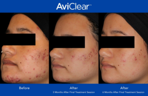 Aviclear before and after for clear skin 4