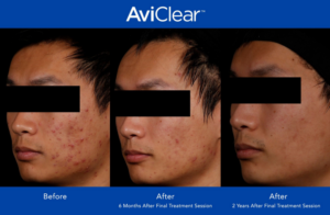 Aviclear before and after clear skin 5