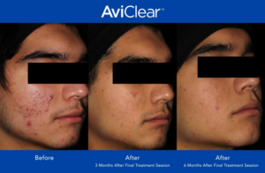 aviclear before and after photos for clear skin 6