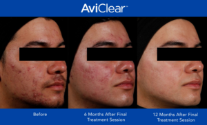 Aviclear before and after for clear skin in colorado 7