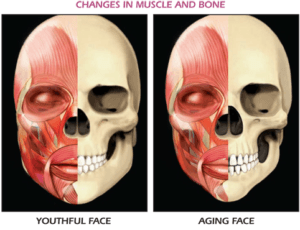 Bone Loss Aging