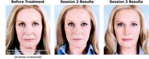 Sculptra before and after