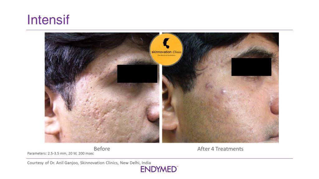 RF Microneedling