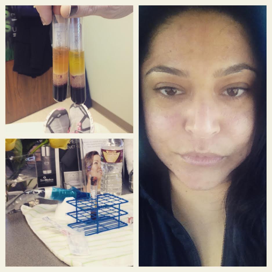 The Plasma Facial A 1st Hand Review Med Spa Louisville CO