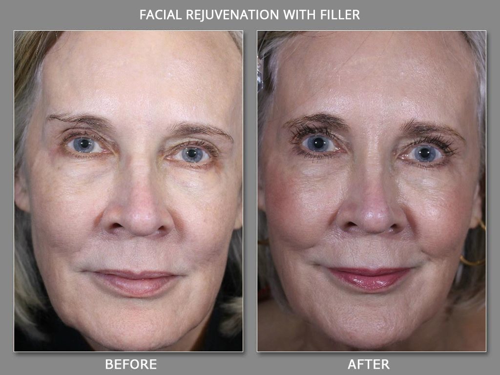 After Care Instructions for Dermal Fillers in Denver Sonata