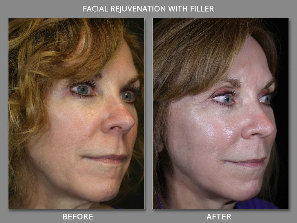 After Care Instructions for Dermal Fillers in Denver Sonata