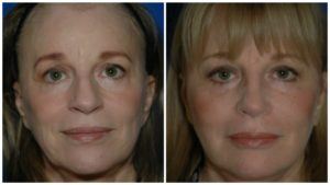 getting a fuller face with fat transfer in denver colorado