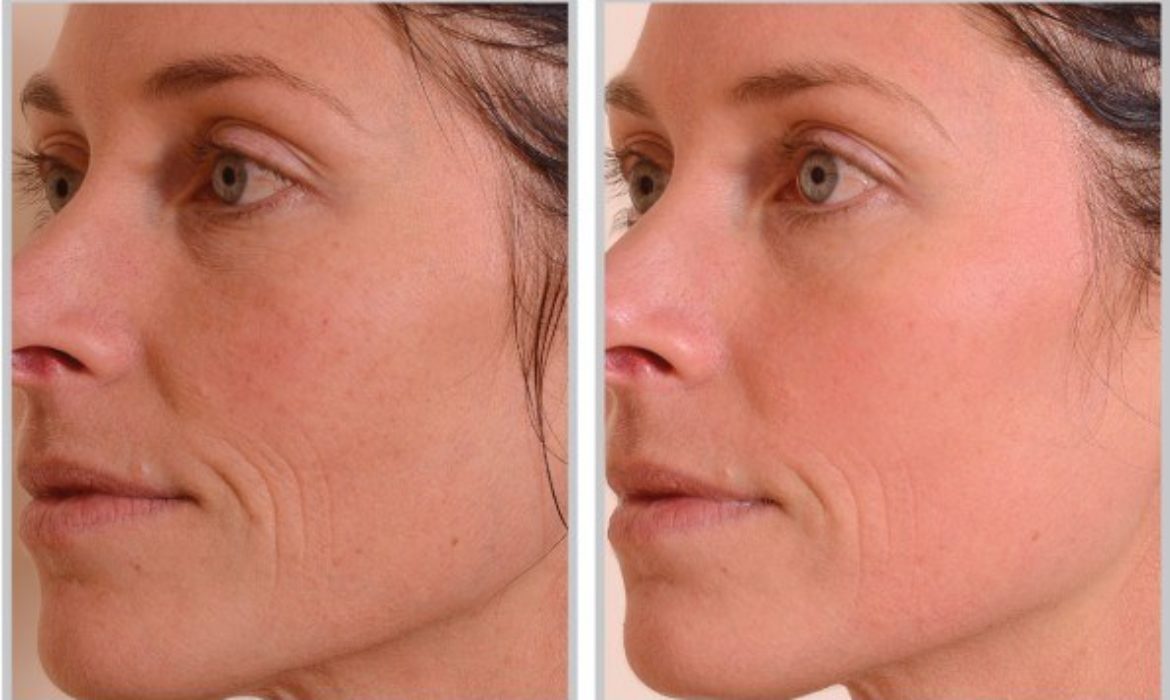 Halo Laser Before and After Acne Scars: Powerful Transformation