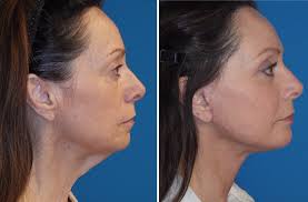 kybella before and after