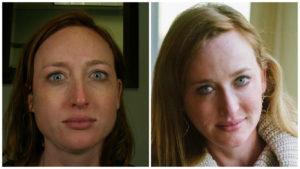 improve the shape of your face with dysport injections in the jaw in colorado