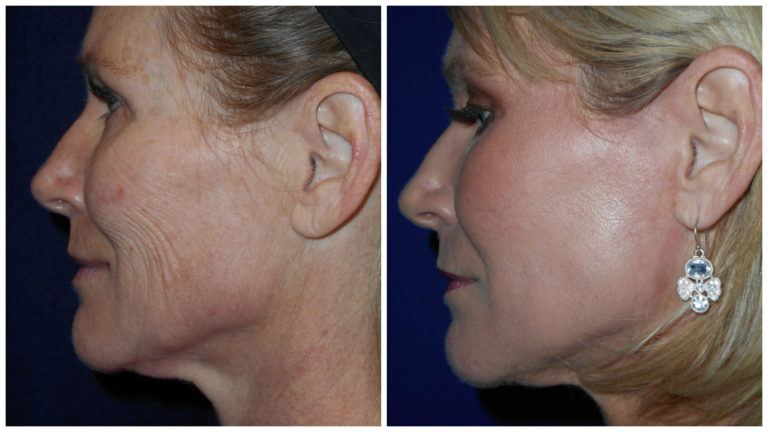 大割引 Best Non-Surgical Facelift! | Turn Back Time With J-Plasma 洋書