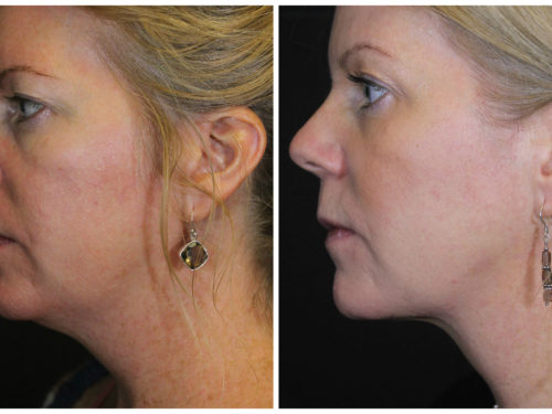 WOW! Transform your jawline with Kybella