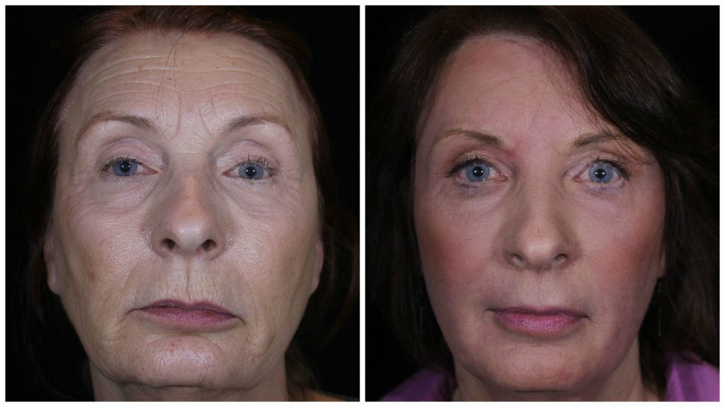 j plasma non surgical facelift before and after