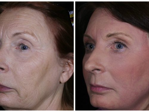What is a Cold Plasma Non-Surgical Facelift?
