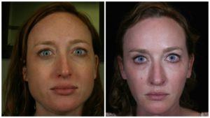 chemical peel before and after in denver