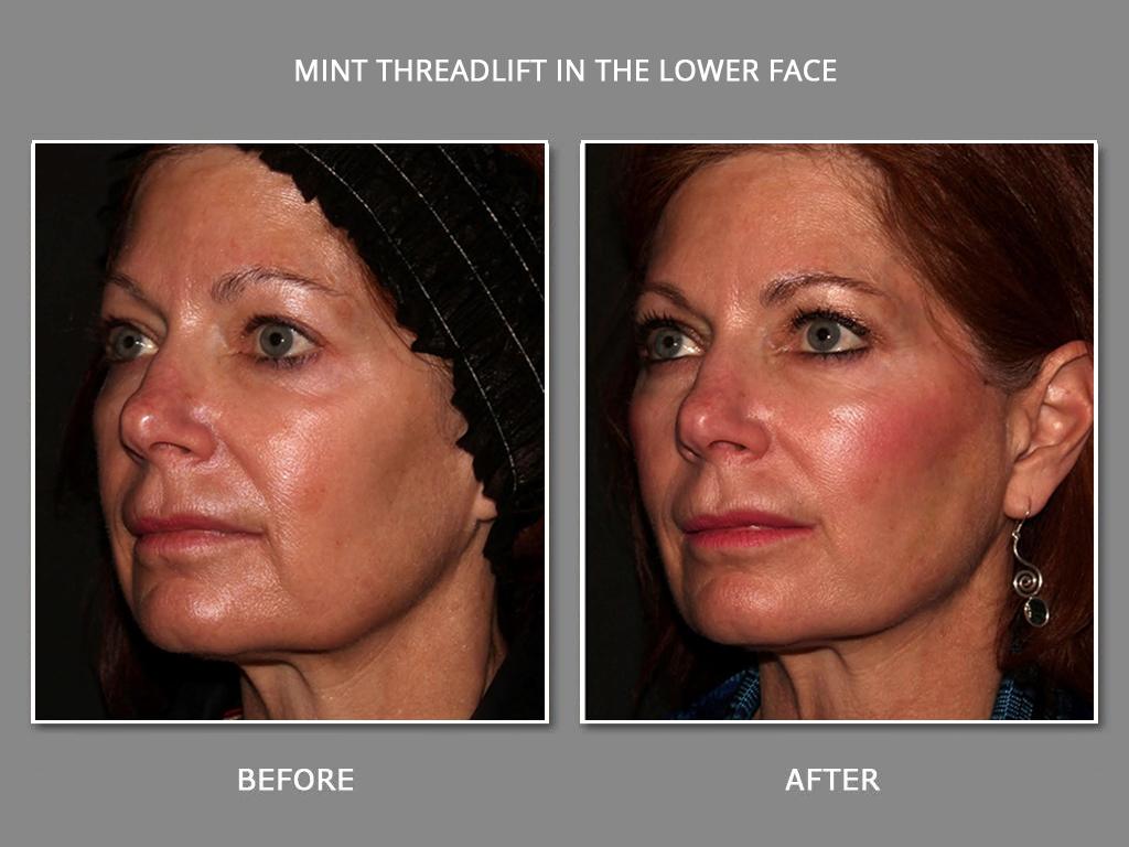 Mint PDO Threads NY: The Future of Non-Surgical Facial Lifting