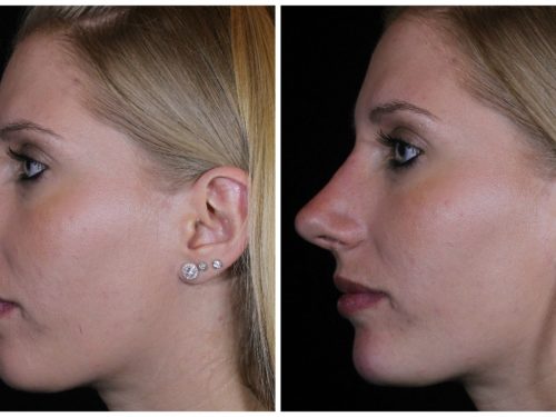 Reshaping your nose – without surgery!