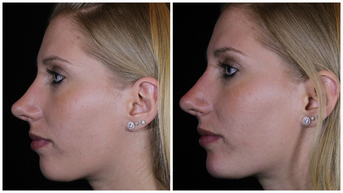 Reshaping Your Nose Without Surgery Med Spa Broomfield