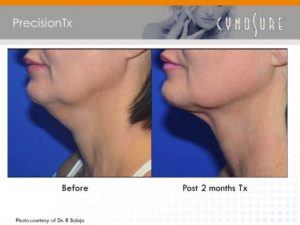 neck lift to get rid of sagging jowls in westminster colorado