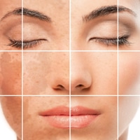 chemical peel for skin discoloration